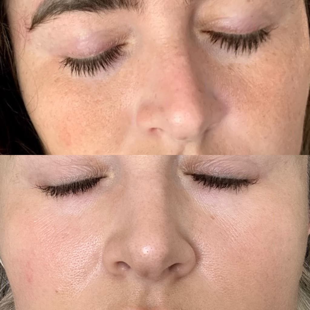 microneedling before and after